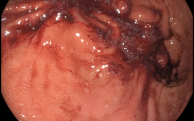 ESG — efekt zabiegu